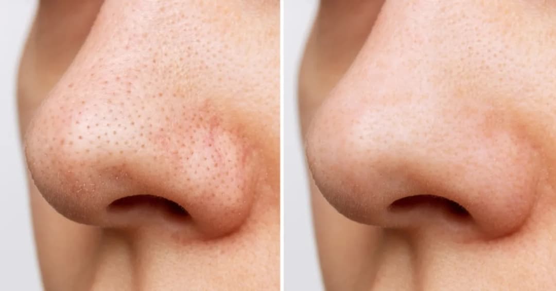 Jak usunąć pryszcza z nosa? Skuteczne metody i porady na co dzień