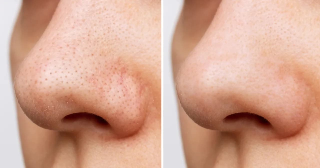 Jak usunąć pryszcza z nosa? Skuteczne metody i porady na co dzień