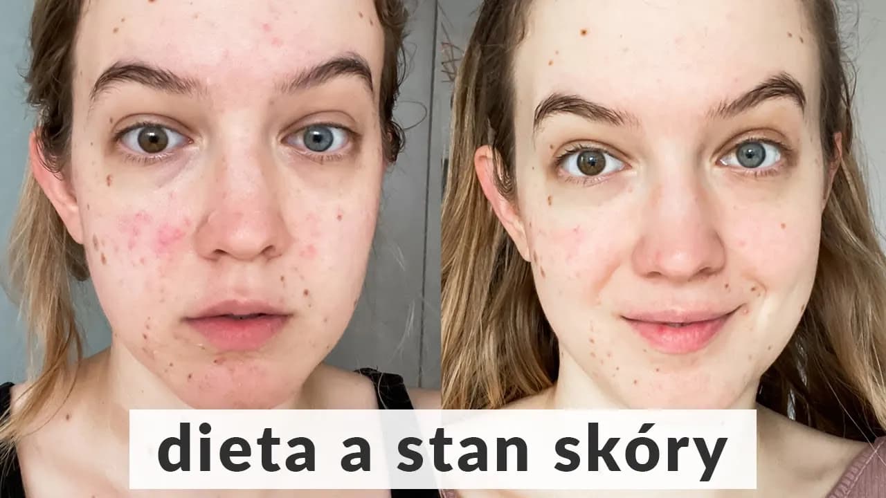 Czego nie jeść aby mieć ładną cerę - unikaj tych szkodliwych produktów