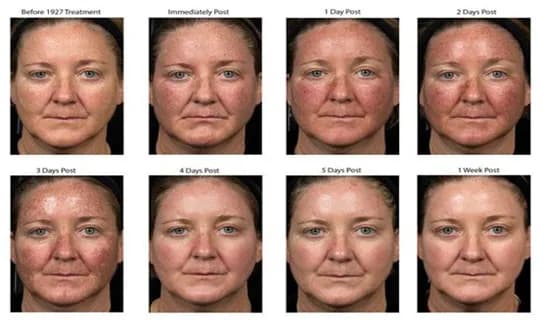 Jak pielęgnować twarz po laserze frakcyjnym, aby uniknąć komplikacji