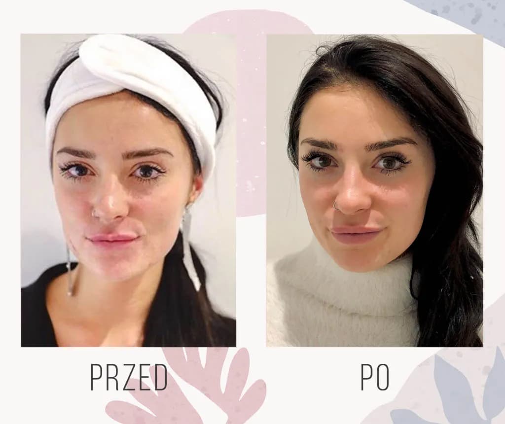 Po jakim czasie widać efekty kwasu hialuronowego? Oczekiwania i rzeczywistość