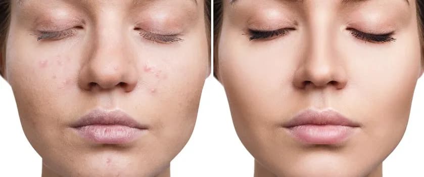 Jak zmniejszyć zaczerwienienie pryszcza - skuteczne metody na ulgę