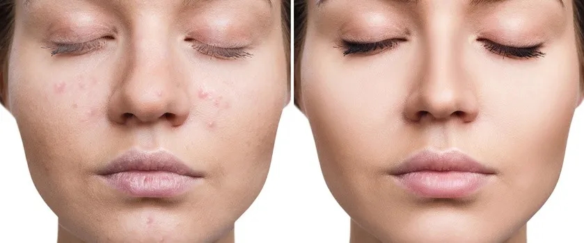 Jak zmniejszyć zaczerwienienie pryszcza - skuteczne metody na ulgę