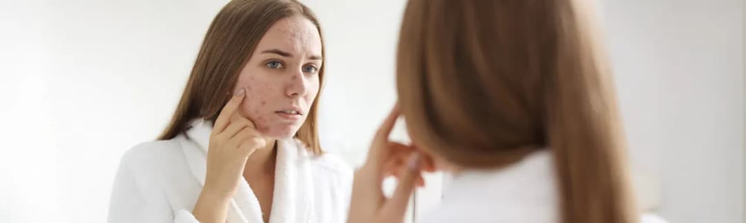 Krem do cery suchej z wypryskami – jak wybrać najlepszy produkt