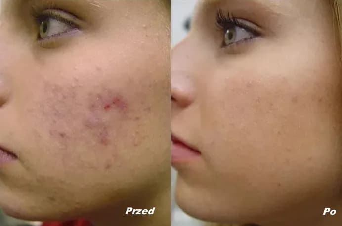 Skuteczne metody na gojenie ran po pryszczach i redukcję blizn