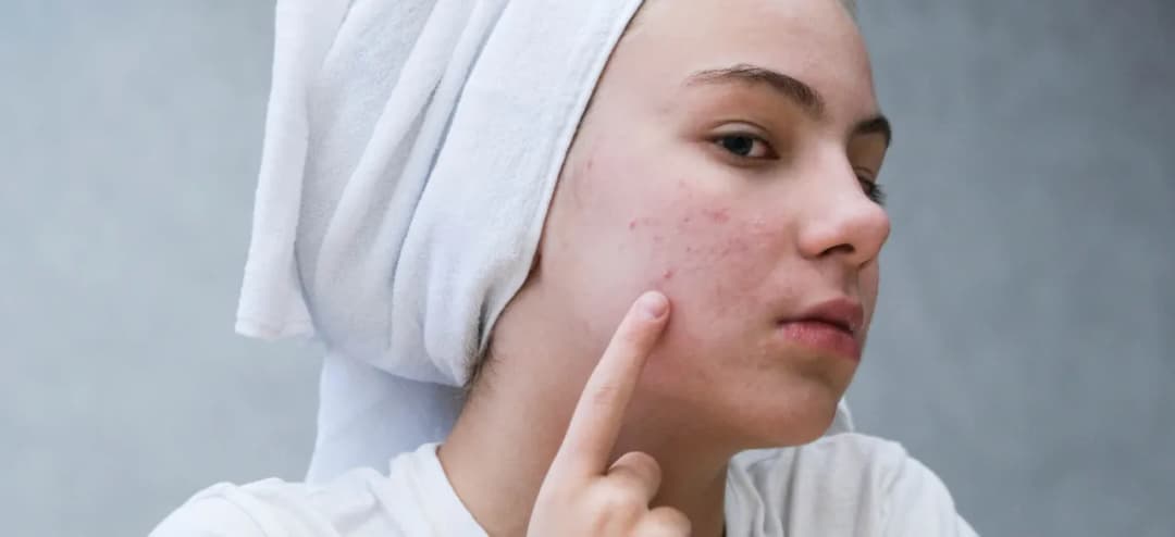 Skuteczne domowe sposoby na pozbycie się podskórnego pryszcza