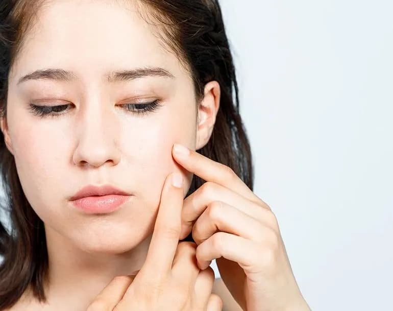 Gdzie nie wyciskać pryszczy? Unikaj tych niebezpiecznych miejsc